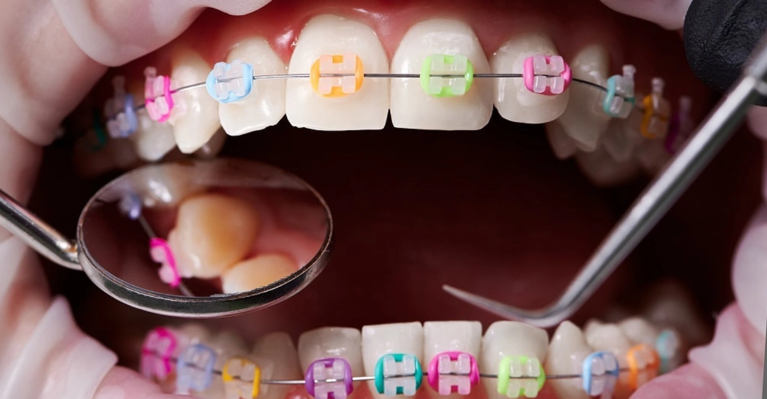 What Is Orthodontics Inblog